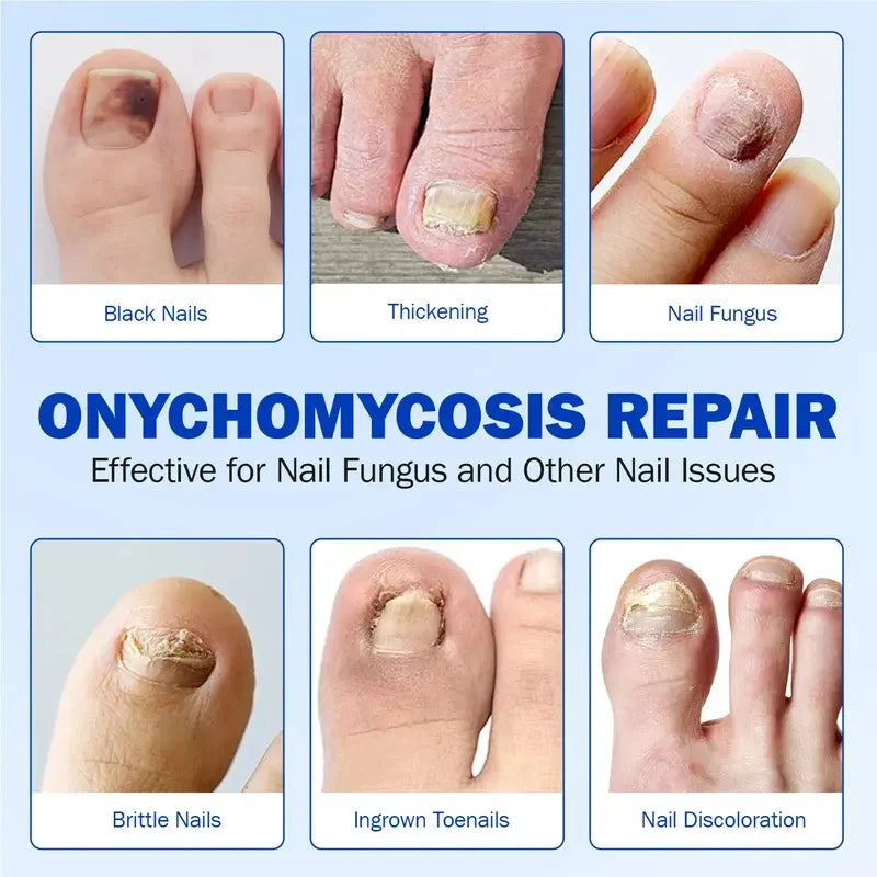 Fungal Nail Patches
