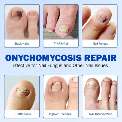Fungal Nail Patches